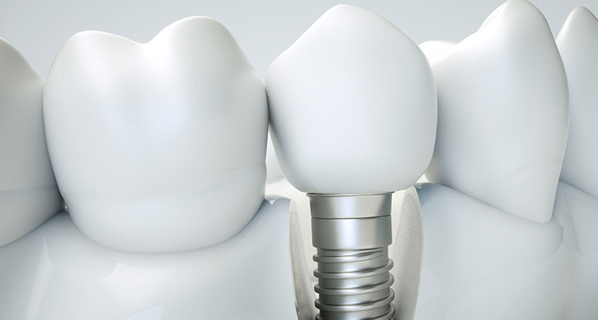 Dental Implant Surgery and Why You Don’t Have to Be Worried