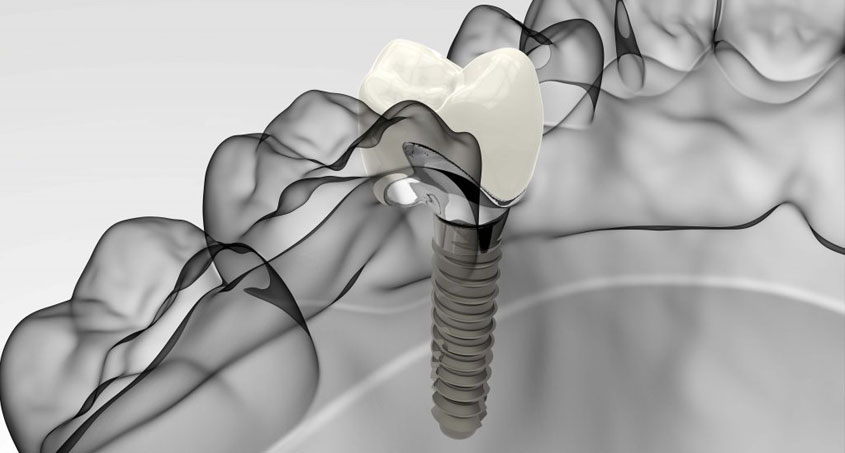 Dental Implant Timelines and What You Should Know